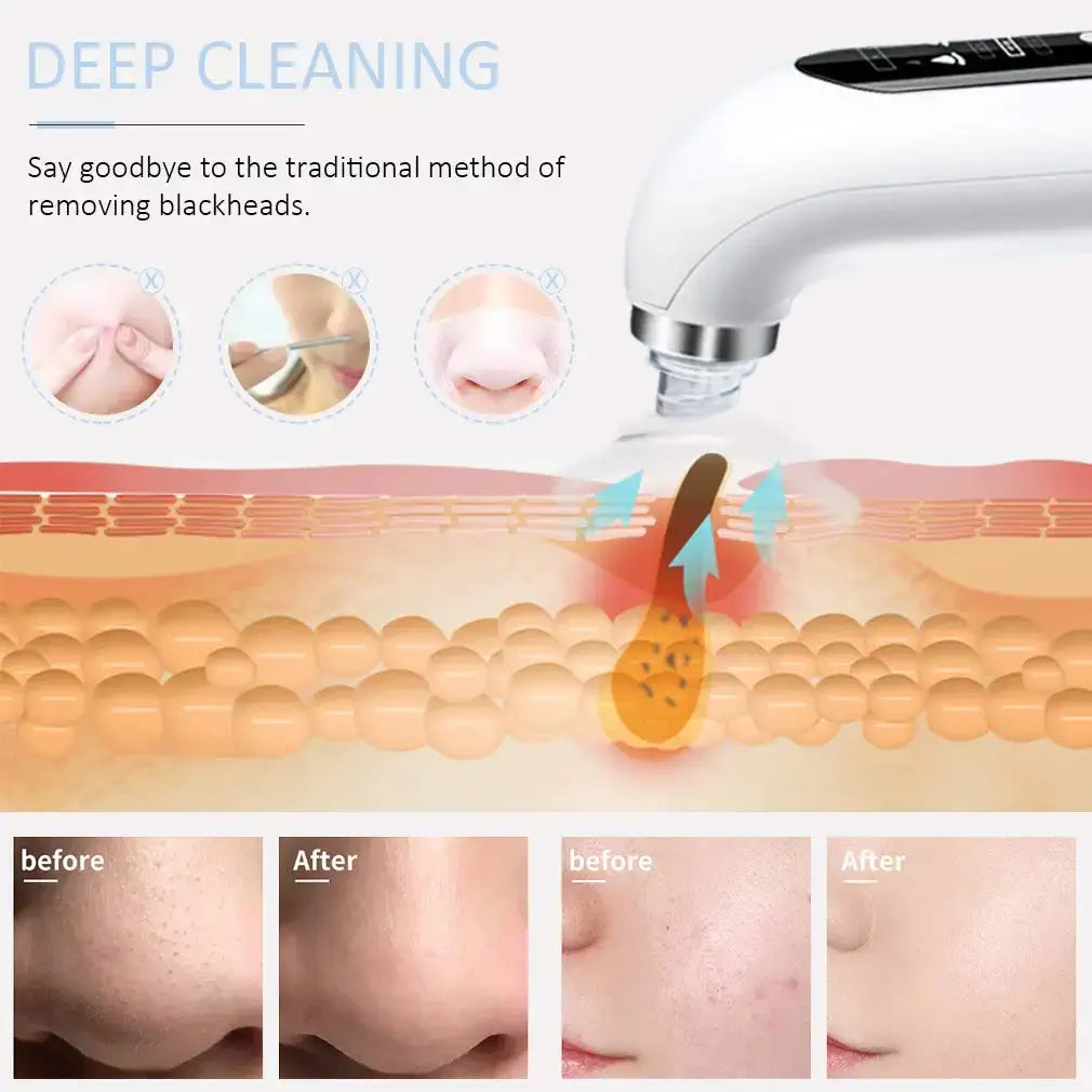 Blackhead Vacuum Suction Remover